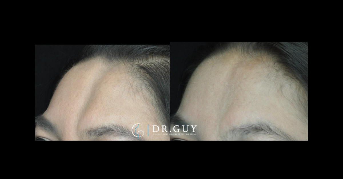30-40 y/o female had fat taken from the abdomen and placed into the defect of the forehead.