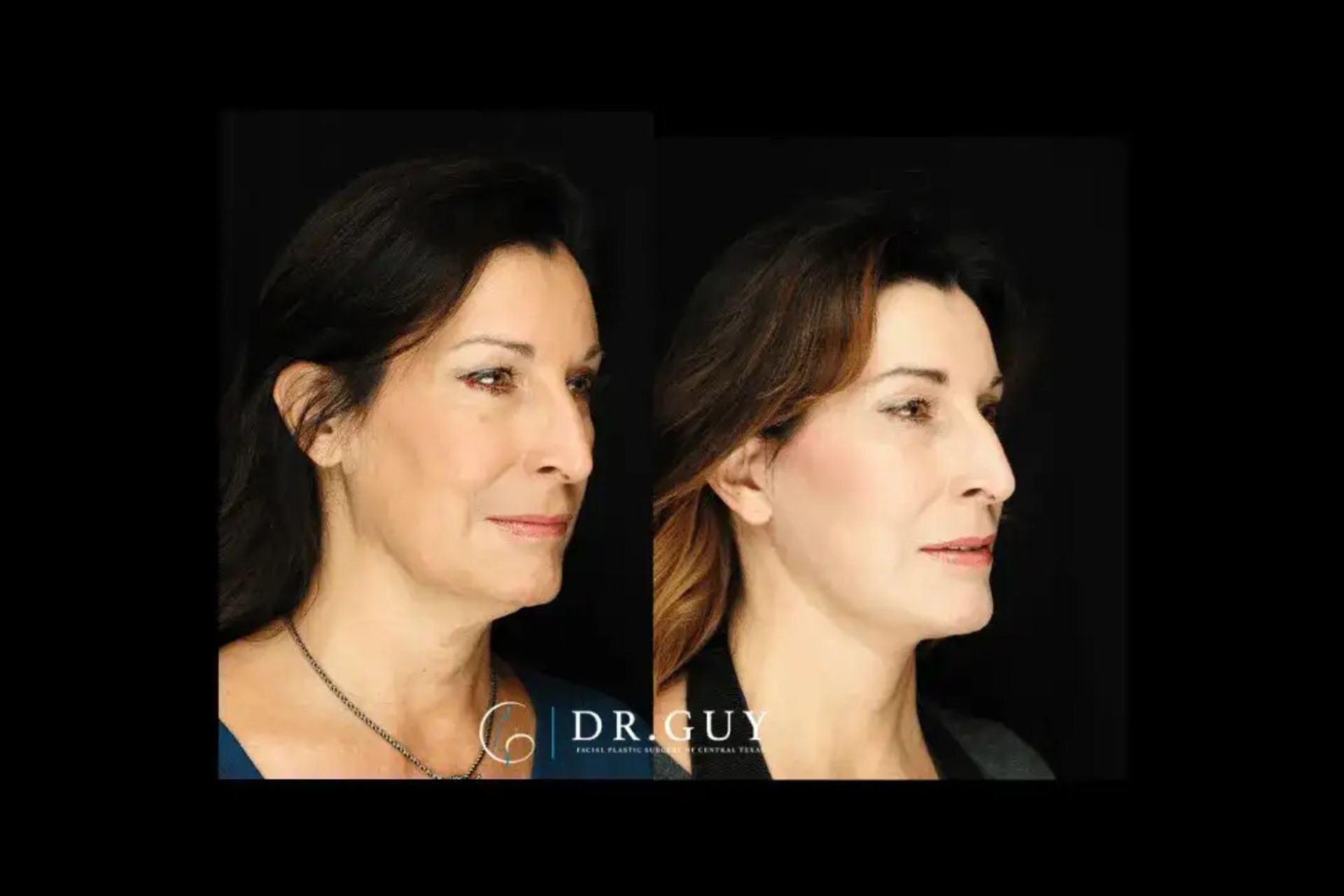 50-60 y/o female underwent a lower face/neck lift
